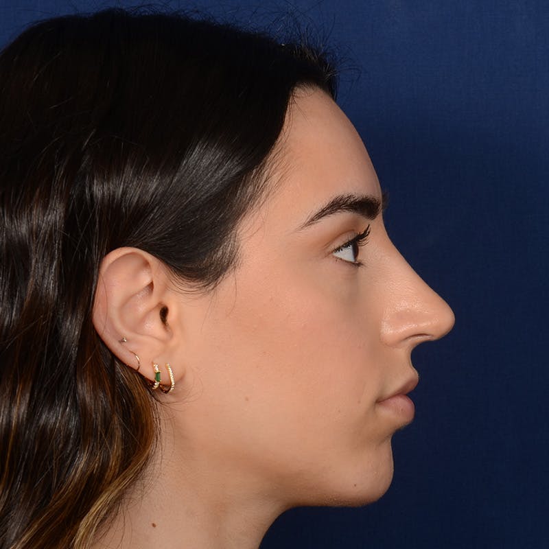 Rhinoplasty w/ Chin Implant Before & After Gallery - Patient 390620 - Image 6
