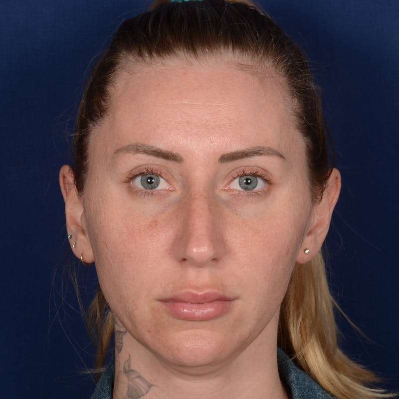 Rhinoplasty w/ Chin Implant Before & After Gallery - Patient 343558 - Image 1