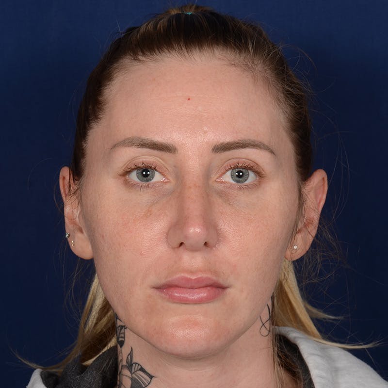 Rhinoplasty w/ Chin Implant Before & After Gallery - Patient 343558 - Image 2