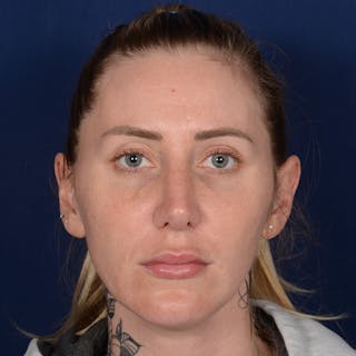 Rhinoplasty w/ Chin Implant Before & After Gallery - Patient 343558 - Image 2