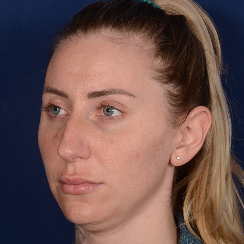 Rhinoplasty w/ Chin Implant Before & After Gallery - Patient 343558 - Image 3