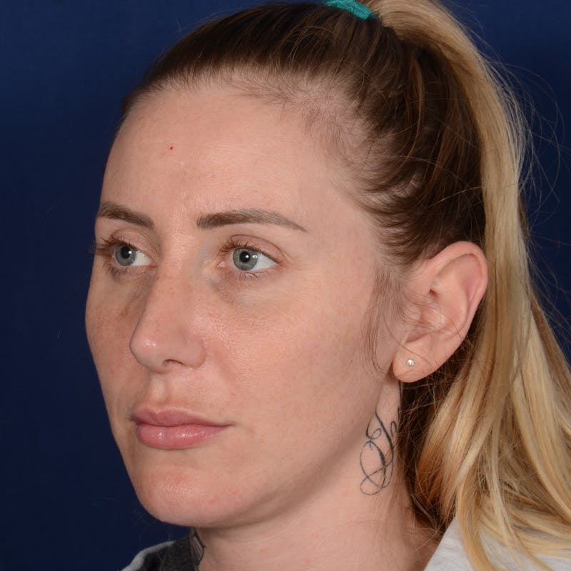 Rhinoplasty w/ Chin Implant Before & After Gallery - Patient 343558 - Image 4