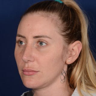 Rhinoplasty w/ Chin Implant Before & After Gallery - Patient 343558 - Image 4