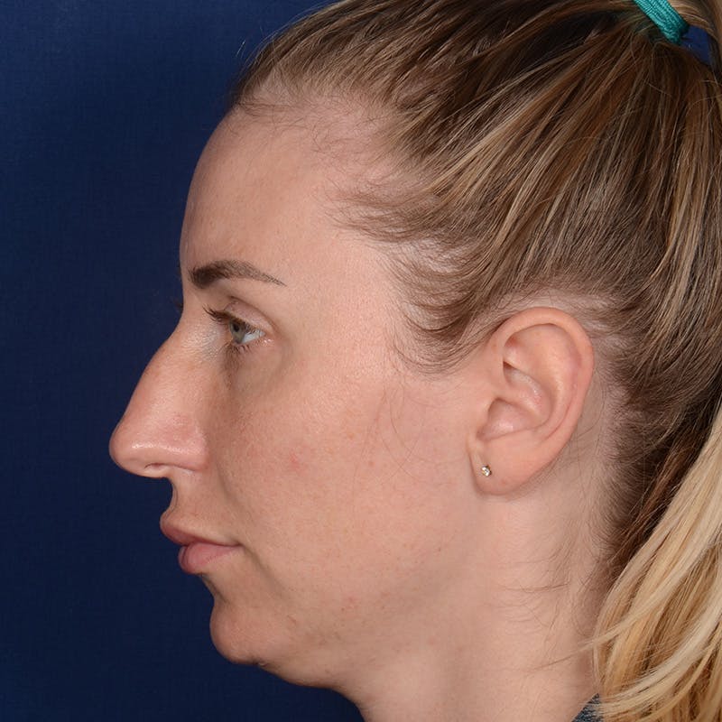 Rhinoplasty w/ Chin Implant Before & After Gallery - Patient 343558 - Image 5