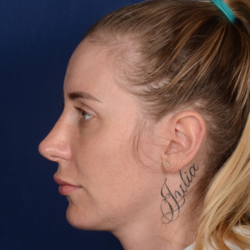 Rhinoplasty w/ Chin Implant Before & After Gallery - Patient 343558 - Image 6