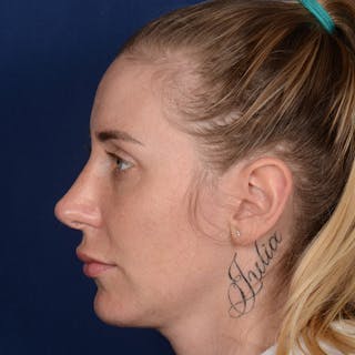 Rhinoplasty w/ Chin Implant Before & After Gallery - Patient 343558 - Image 6