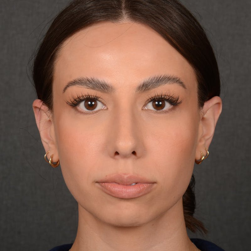 Chin Augmentation Before & After Gallery - Patient 151996 - Image 1