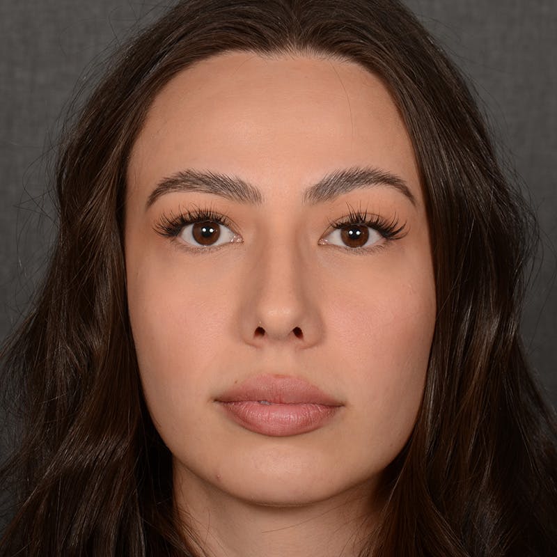 Chin Augmentation Before & After Gallery - Patient 151996 - Image 2