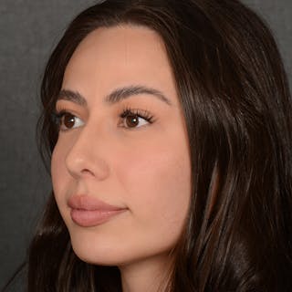 Chin Augmentation Before & After Gallery - Patient 151996 - Image 4