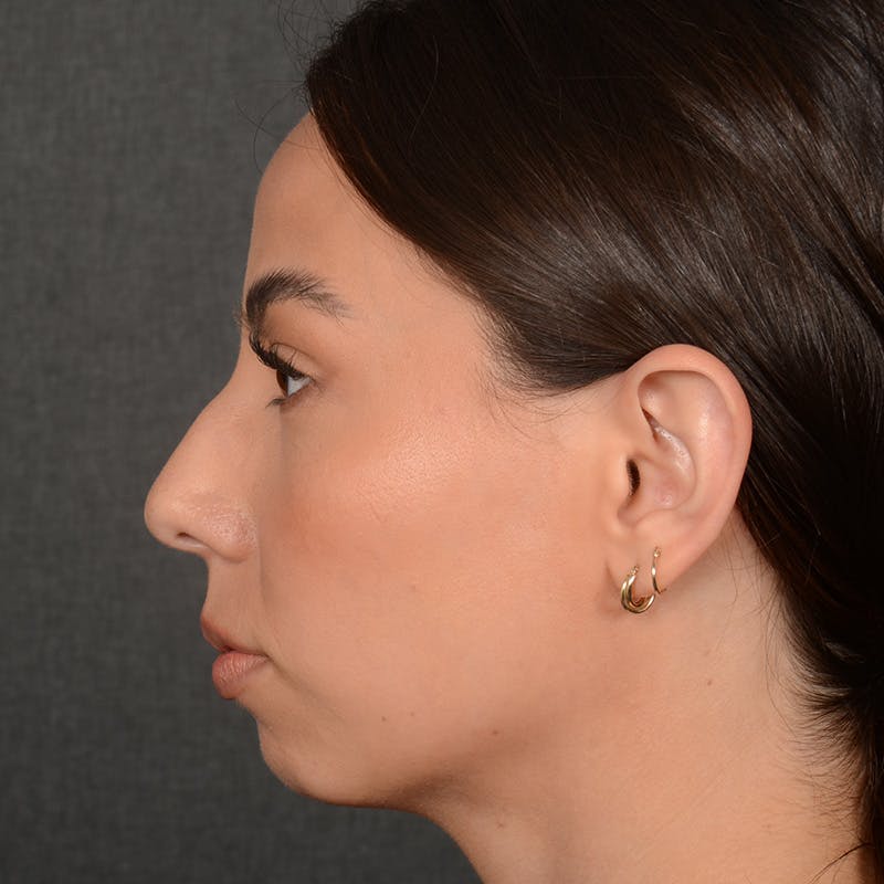 Chin Augmentation Before & After Gallery - Patient 151996 - Image 5