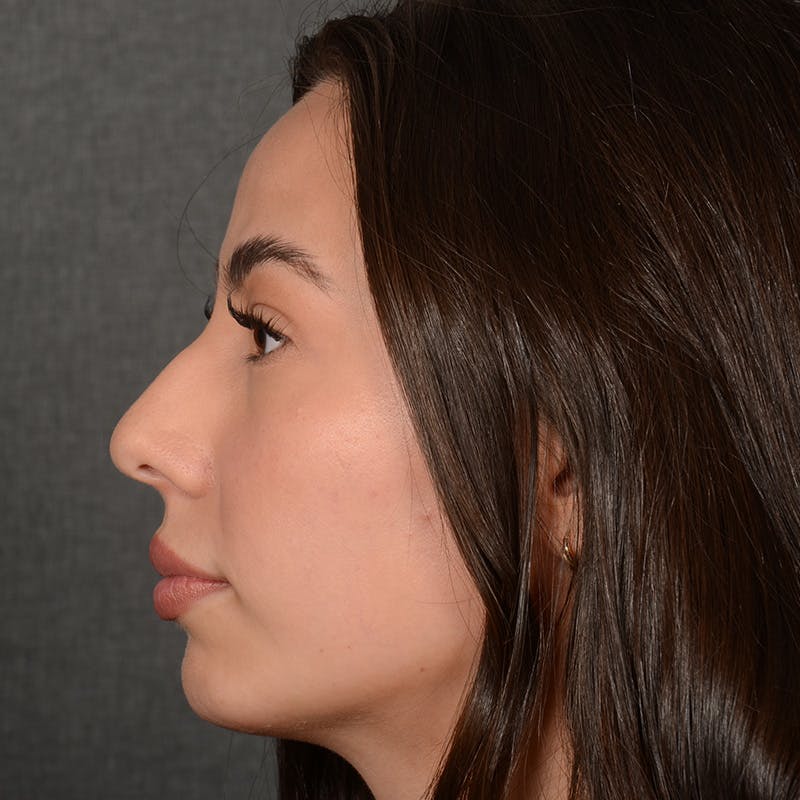 Chin Augmentation Before & After Gallery - Patient 151996 - Image 6