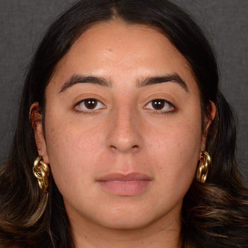 Rhinoplasty w/ Chin Implant Before & After Gallery - Patient 291389 - Image 1