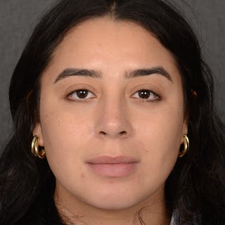 Rhinoplasty w/ Chin Implant Before & After Gallery - Patient 291389 - Image 2