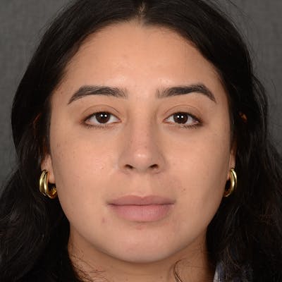 Chin Augmentation Before & After Gallery - Patient 359163 - Image 2