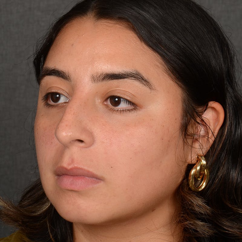 Rhinoplasty w/ Chin Implant Before & After Gallery - Patient 291389 - Image 3