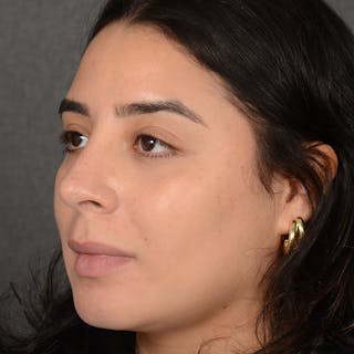 Rhinoplasty w/ Chin Implant Before & After Gallery - Patient 291389 - Image 4