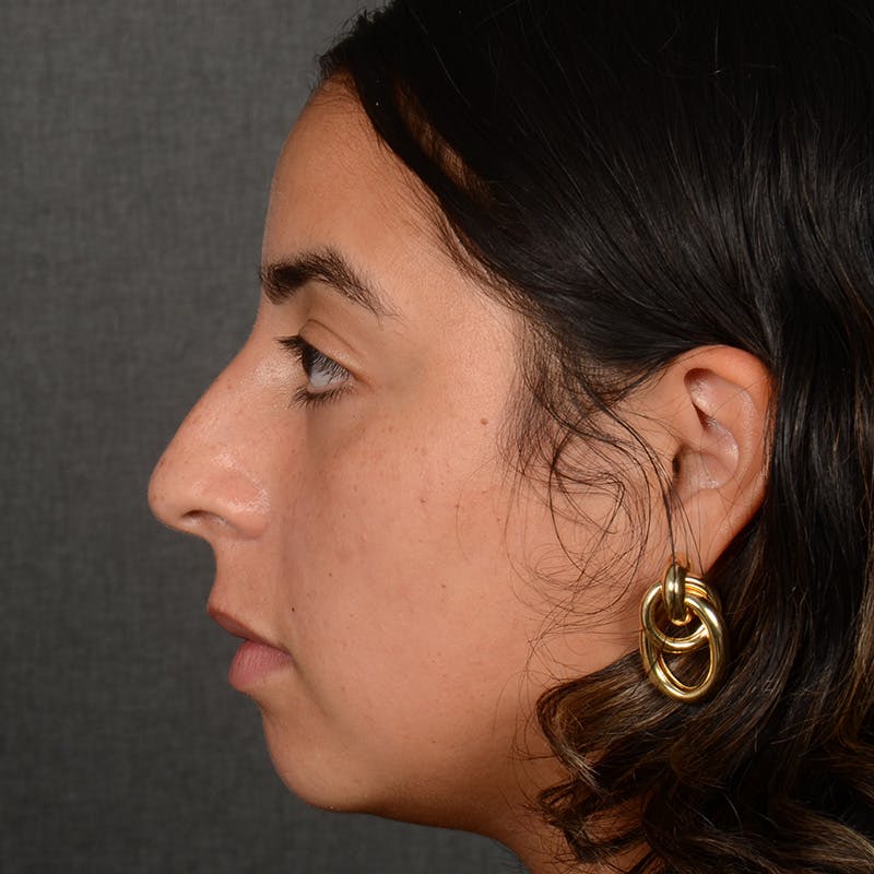 Rhinoplasty w/ Chin Implant Before & After Gallery - Patient 291389 - Image 5