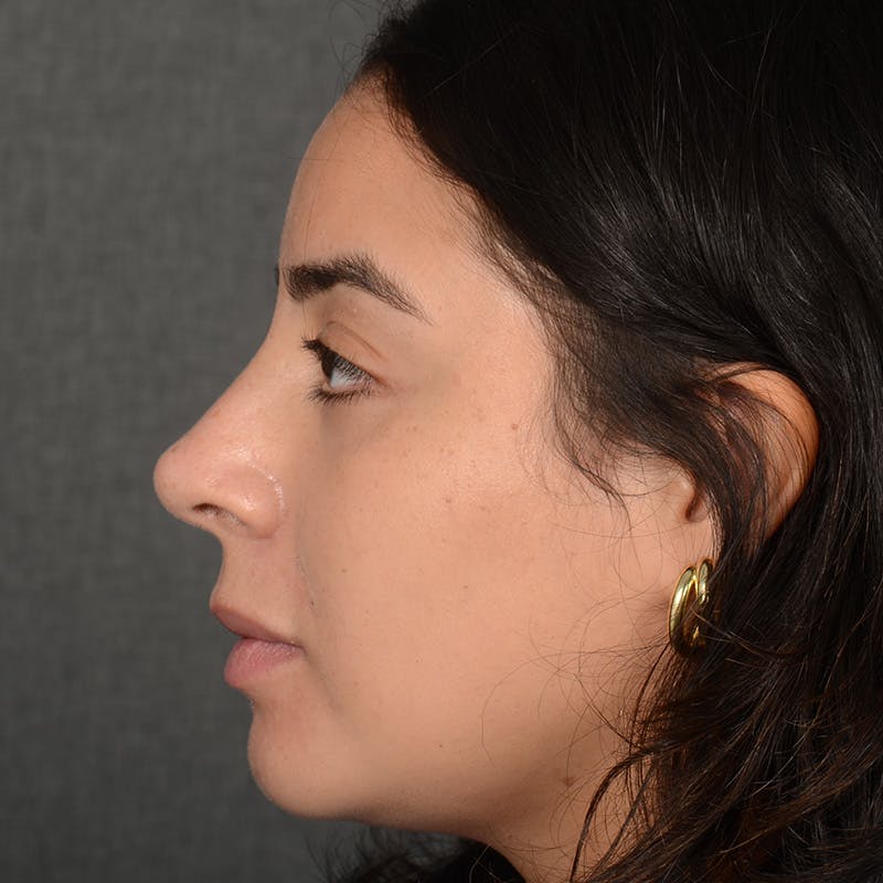 Rhinoplasty w/ Chin Implant Before & After Gallery - Patient 291389 - Image 6