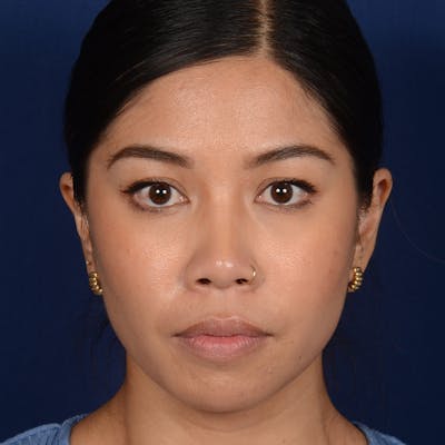 Female Rhinoplasty Before & After Gallery - Patient 271035 - Image 1