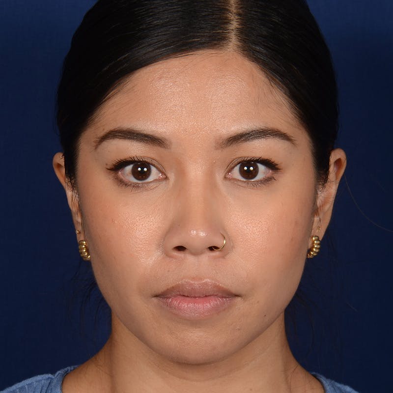 Female Rhinoplasty Before & After Gallery - Patient 271035 - Image 1