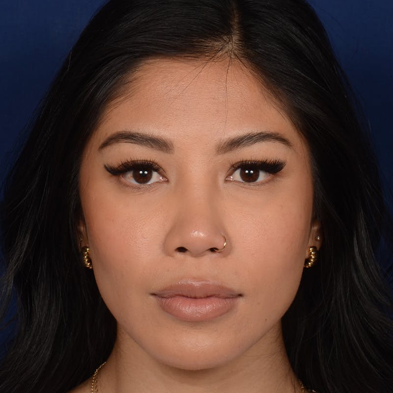 Female Rhinoplasty Before & After Gallery - Patient 271035 - Image 2