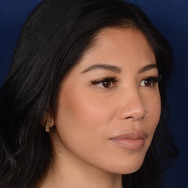 Female Rhinoplasty Before & After Gallery - Patient 271035 - Image 4