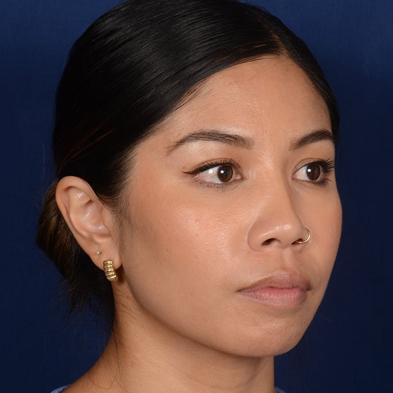 Female Rhinoplasty Before & After Gallery - Patient 271035 - Image 3