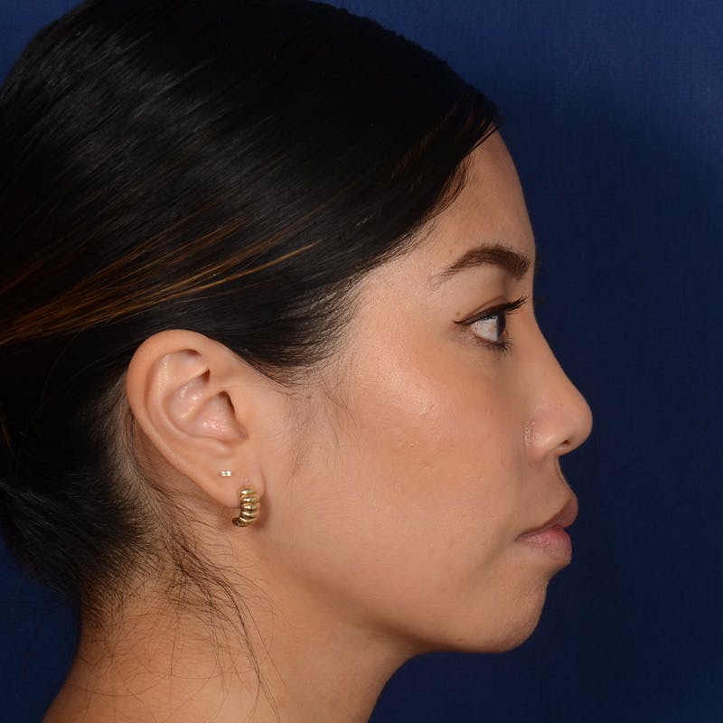Female Rhinoplasty Before & After Gallery - Patient 271035 - Image 5
