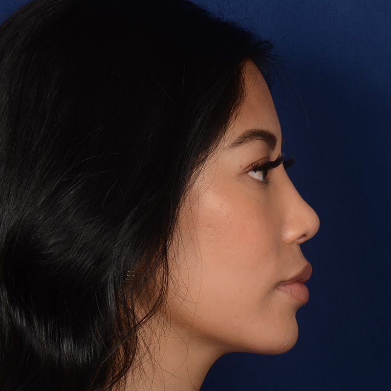 Female Rhinoplasty Before & After Gallery - Patient 271035 - Image 6