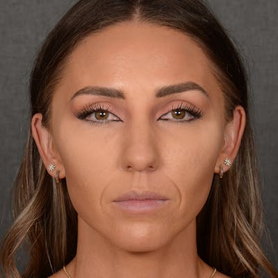 Chin Augmentation Before & After Gallery - Patient 443545 - Image 1