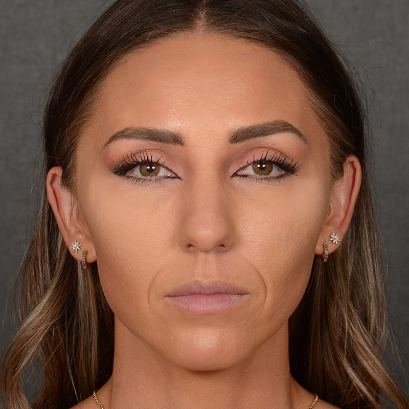 Chin Augmentation Before & After Gallery - Patient 443545 - Image 1