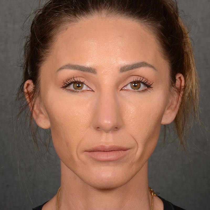 Chin Augmentation Before & After Gallery - Patient 443545 - Image 2