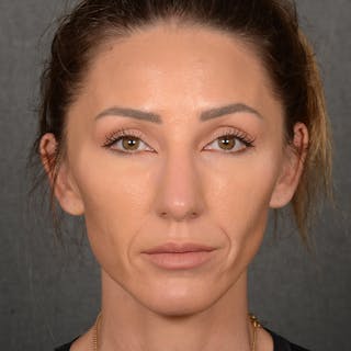 Chin Augmentation Before & After Gallery - Patient 443545 - Image 2