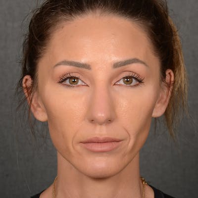 Chin Augmentation Before & After Gallery - Patient 443545 - Image 2