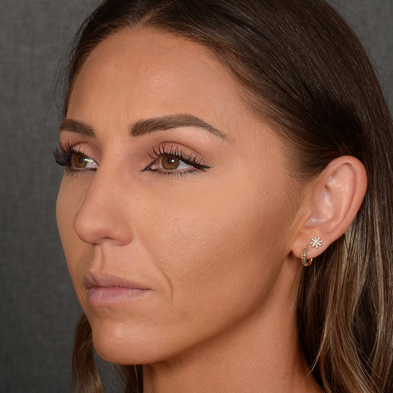 Chin Augmentation Before & After Gallery - Patient 443545 - Image 3