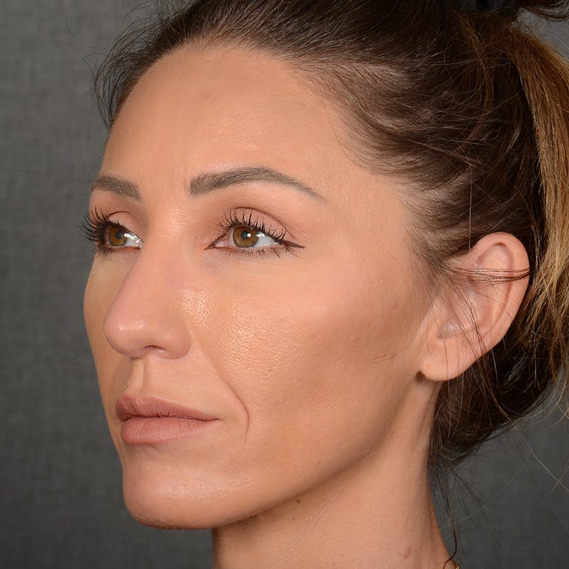 Chin Augmentation Before & After Gallery - Patient 443545 - Image 4