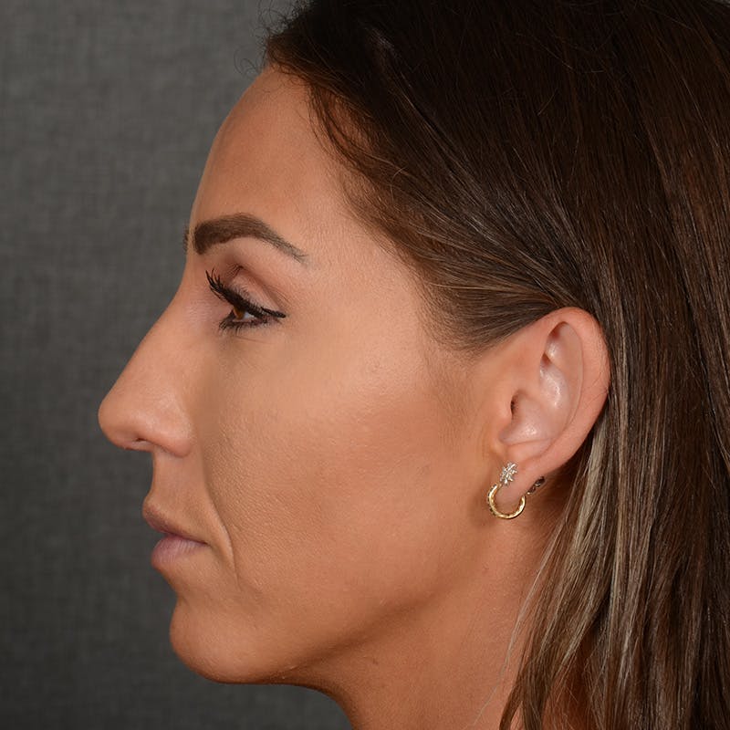 Chin Augmentation Before & After Gallery - Patient 443545 - Image 5