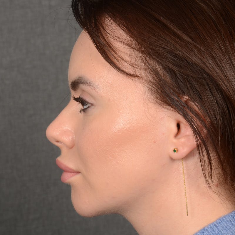 Chin Augmentation Before & After Gallery - Patient 209639 - Image 6