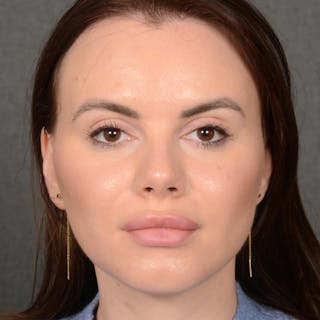 Chin Augmentation Before & After Gallery - Patient 209639 - Image 2