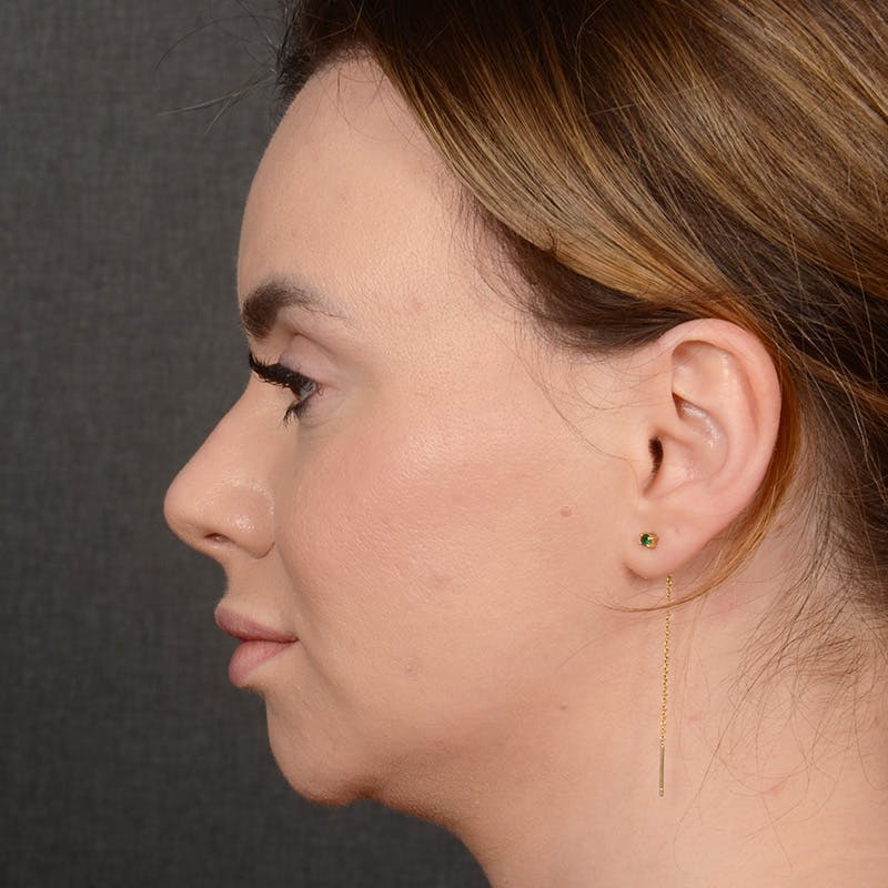 Chin Augmentation Before & After Gallery - Patient 209639 - Image 5