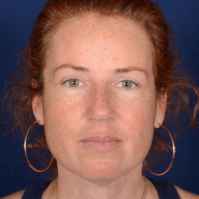 Chin Augmentation Before & After Gallery - Patient 967267 - Image 1