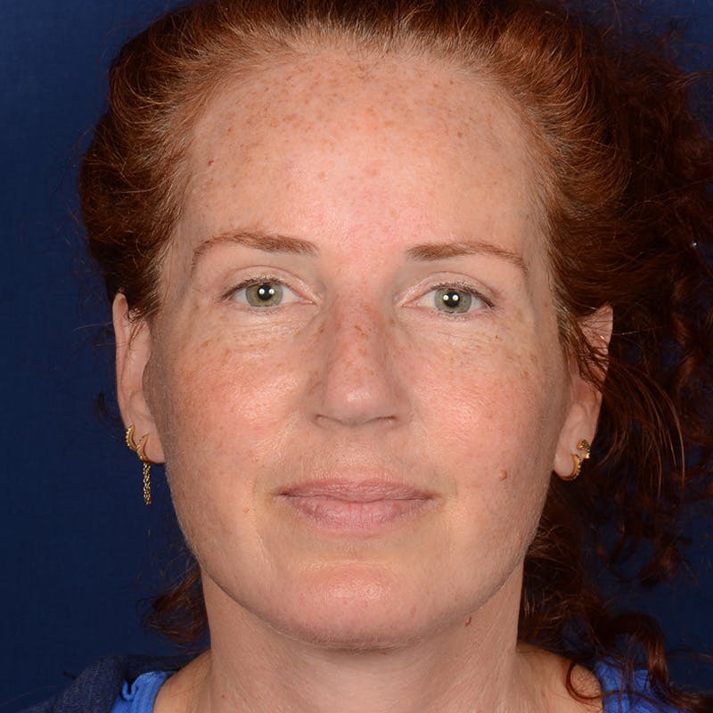 Chin Augmentation Before & After Gallery - Patient 967267 - Image 2