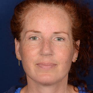 Chin Augmentation Before & After Gallery - Patient 967267 - Image 2