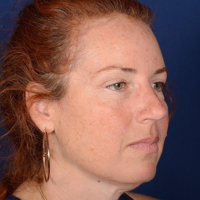 Chin Augmentation Before & After Gallery - Patient 967267 - Image 3