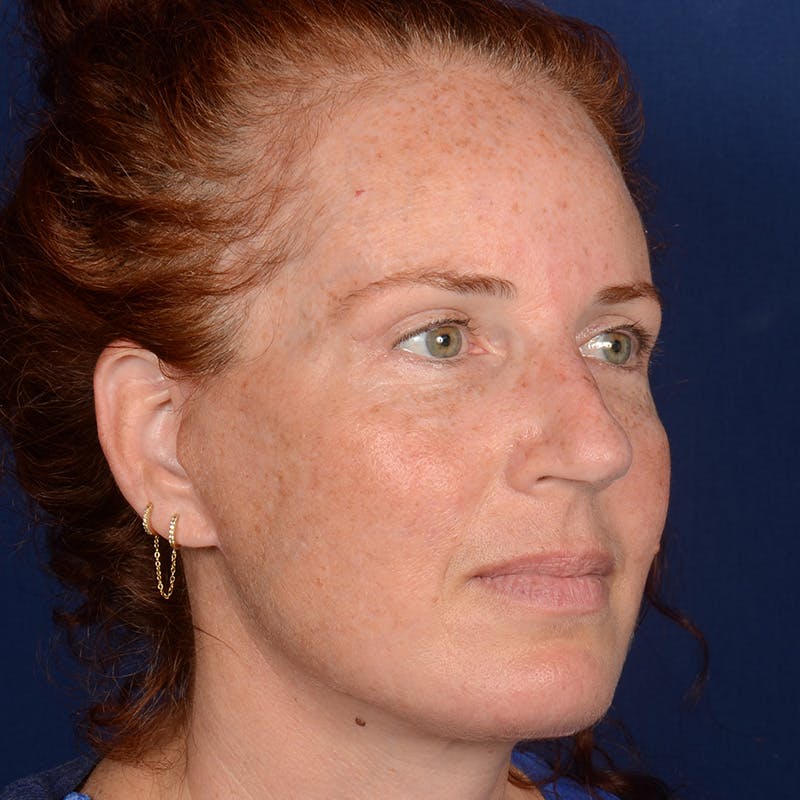 Chin Augmentation Before & After Gallery - Patient 967267 - Image 4