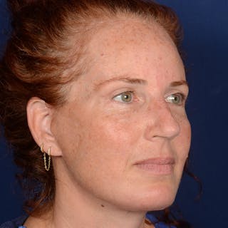 Chin Augmentation Before & After Gallery - Patient 967267 - Image 4