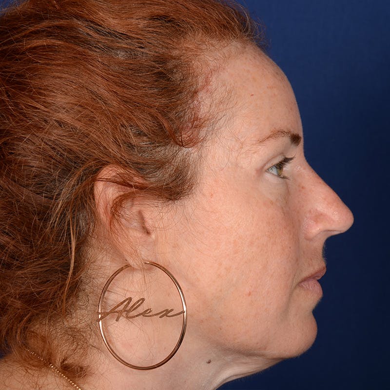 Chin Augmentation Before & After Gallery - Patient 967267 - Image 5