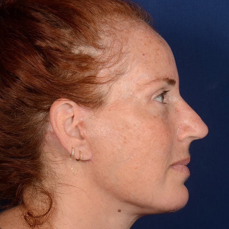 Chin Augmentation Before & After Gallery - Patient 967267 - Image 6