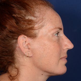 Chin Augmentation Before & After Gallery - Patient 967267 - Image 6