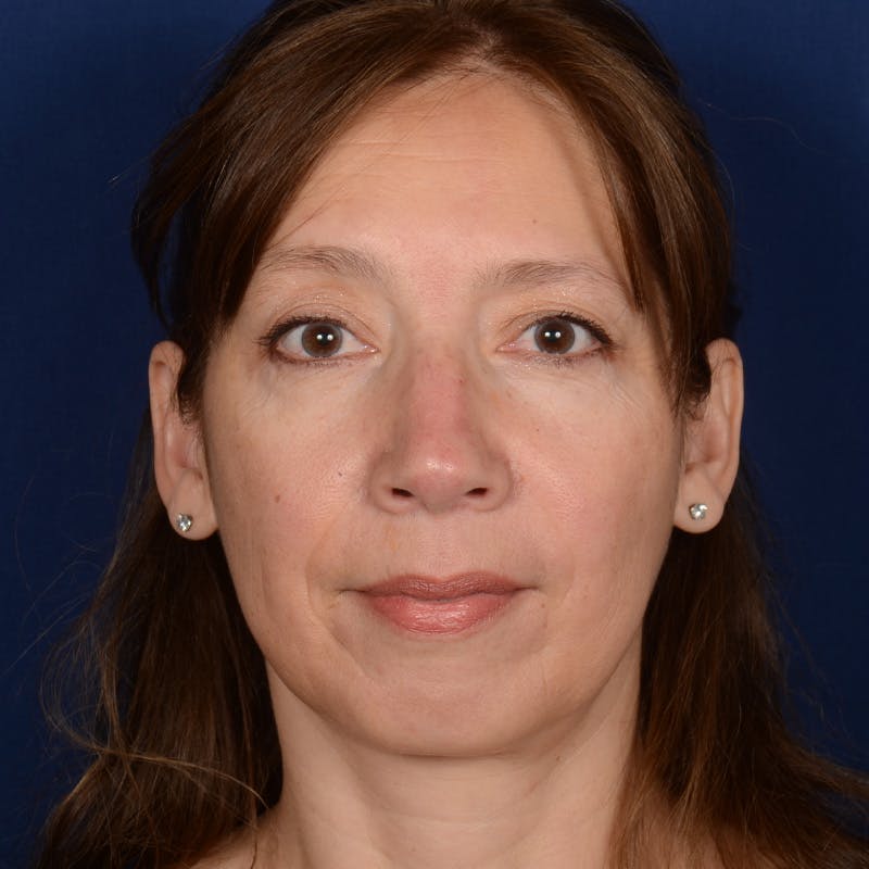 Chin Augmentation Before & After Gallery - Patient 642948 - Image 1